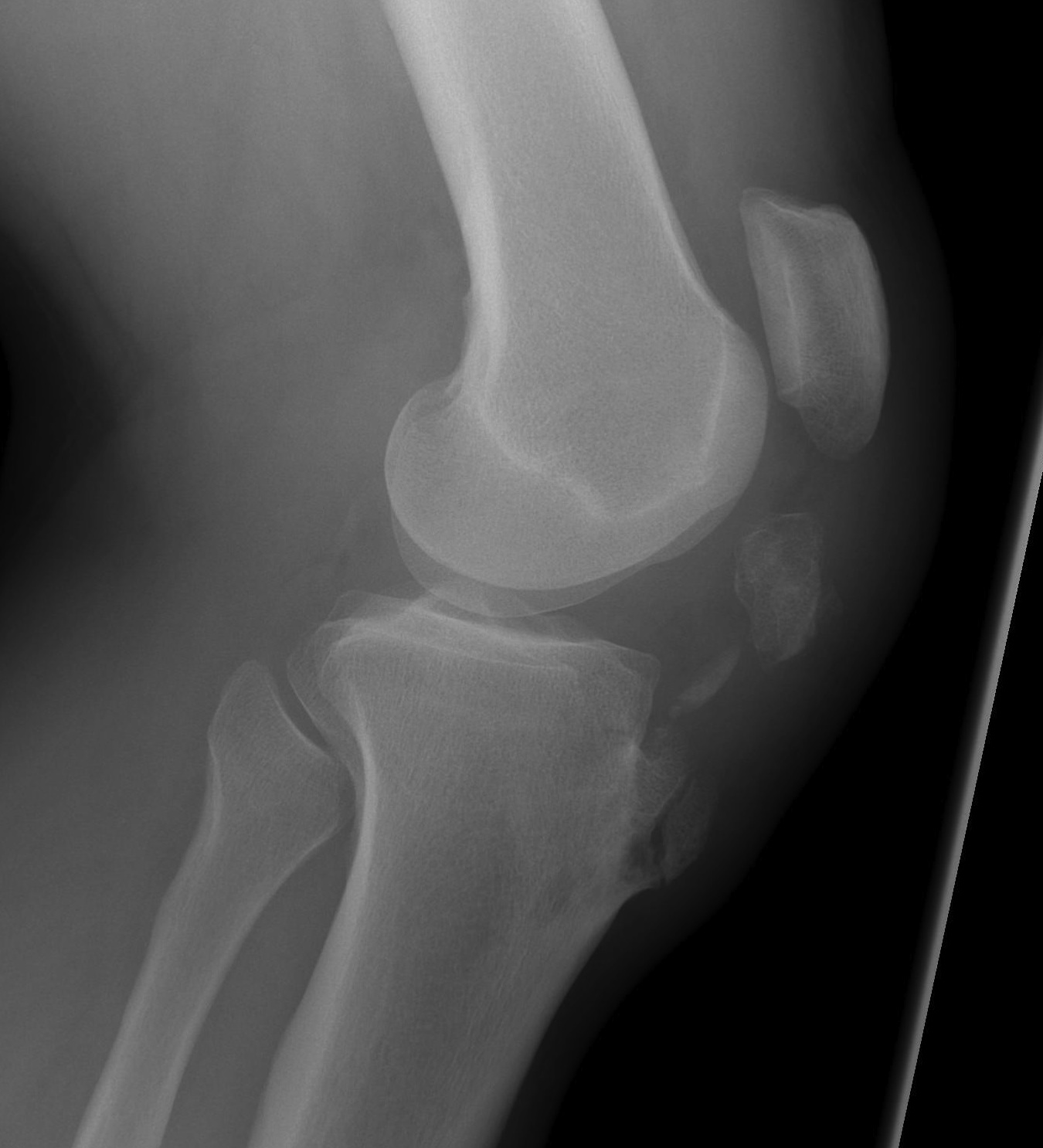 Patella Tendon Avulsion